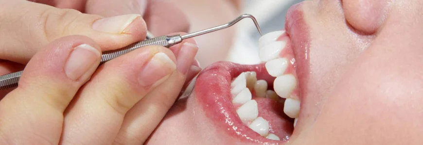 How Often Should You Get Teeth Cleaning in Dubai?