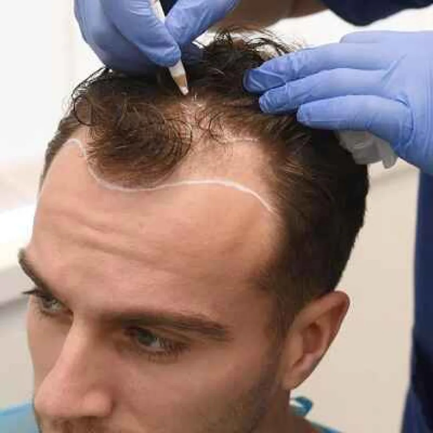 How to Choose the Right Surgeon for Hair Transplant
