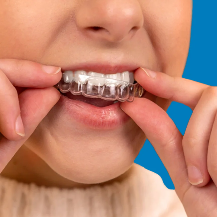 Are Custom Dental Retainers Better Than Store-Bought Ones?