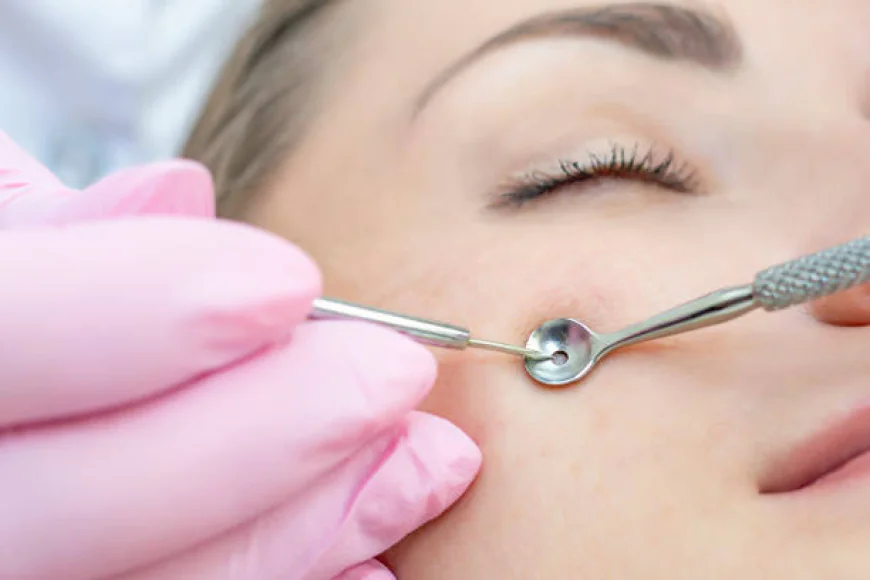 Pimples Treatment in Dubai to Boost Confidence and Glow