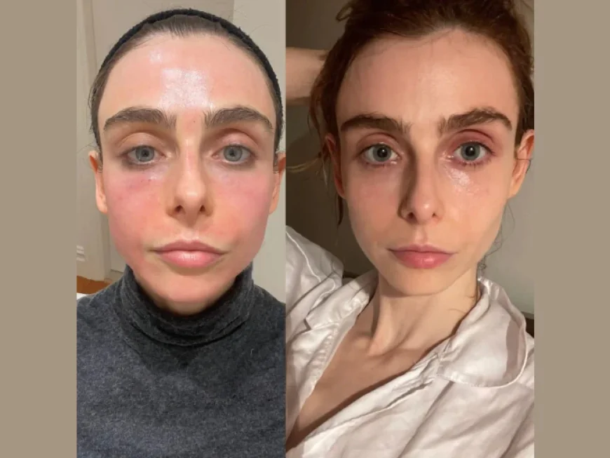 Radiofrequency (RF) Microneedling Treatment in Dubai Skin Rejuvenation Treatment