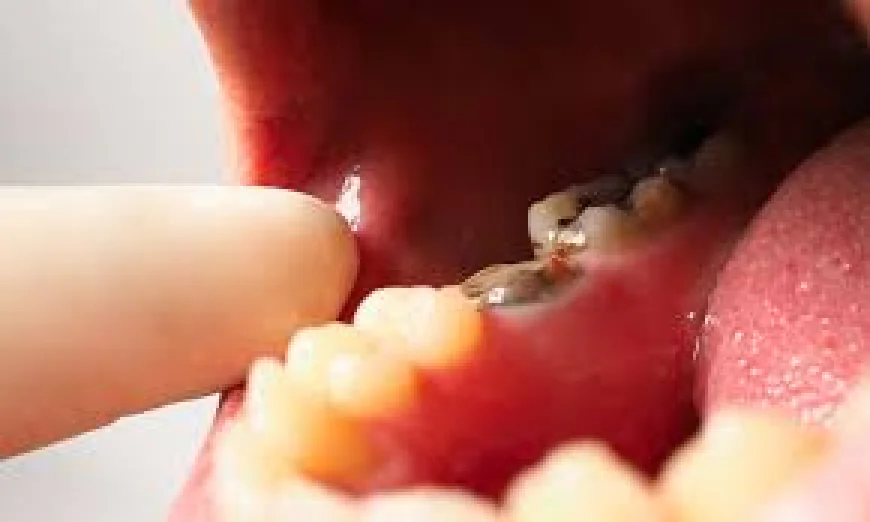 Root Canal on Back Teeth: Common Patient Questions