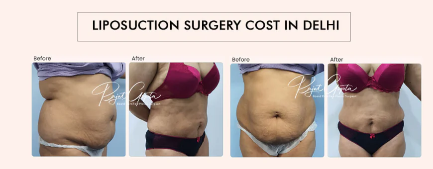 Liposuction Surgery Cost in Delhi: What’s Included and What’s Not