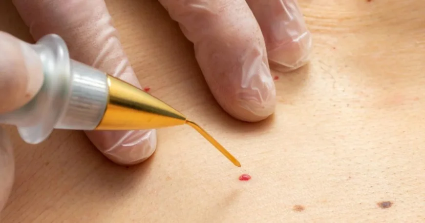 Skin Tag Removal in Dubai