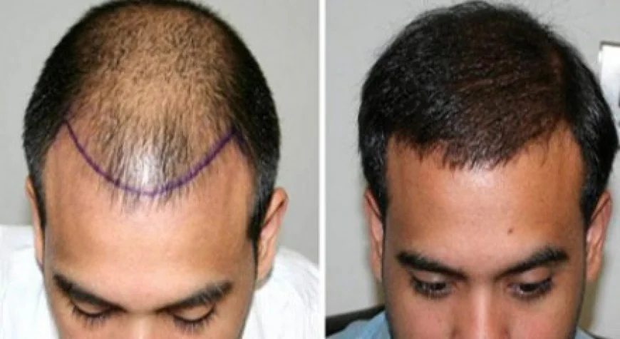 How is a natural hair transplant performed in Riyadh? A simple explanation