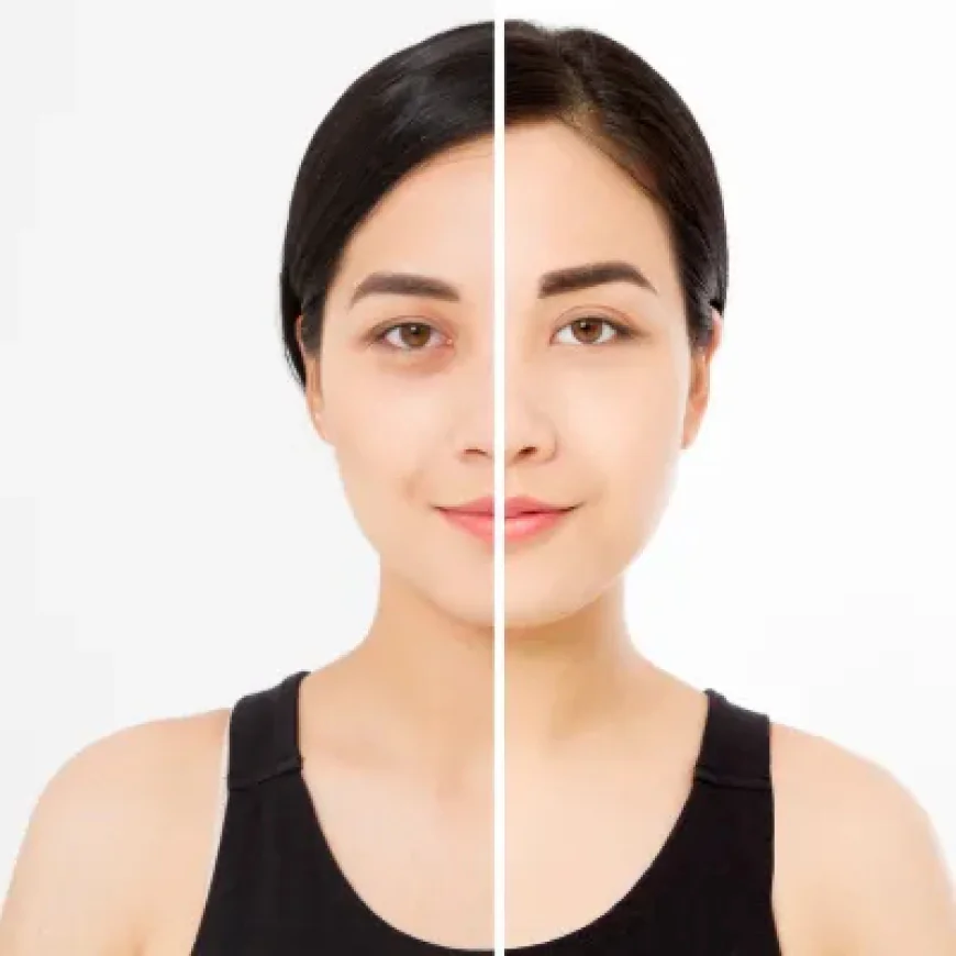 Can PRP Therapy Treat Stubborn Dark Circles?