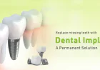 Is India Good for Dental Implants? A Complete Guide for Patients