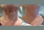 Skin Tightening Treatment in Dubai for Long-Lasting Aesthetic Improvements