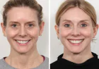 Best Plastic Surgeons in Dubai: Achieving Natural Beauty with Thread Lift