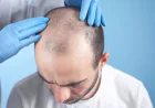 Hair Transplant in Islamabad: Why Choose a Certified Surgeon