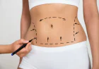 Tummy Tuck in Islamabad: Latest Advances in Cosmetic Surgery