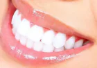 Teeth Whitening in Islamabad: Expert Tips for Long-Lasting Results