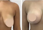 Breast Reduction in Dubai for Refined Feminine Contours