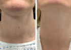 Best Doctors in dubai for Collagen-Boosting Radiofrequency Microneedling