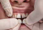 Dental Veneers in Diamond Bar, CA | Trusted Dentist in Diamond Bar