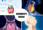 Hashimoto’s Disease