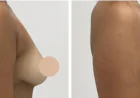 Advanced Techniques for Breast Lift in Dubai