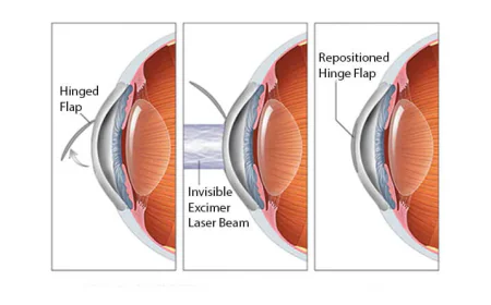 Lasik Surgery in Delhi - Dr Anisha Gupta