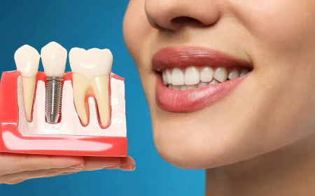 Are Dental Implants Safe, Effective, and Worth It for Missing Teeth?