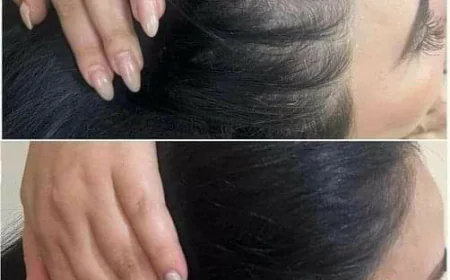 Hybrid Hair Transplant in Dubai: Advanced Solutions for Women