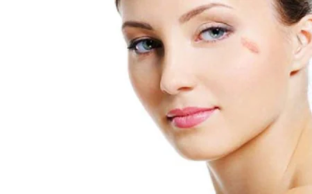 How Long Does It Take to Heal After Birthmark Removal?