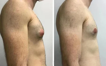 Best Gynecomastia Surgeons in dubai for Comfort and Care