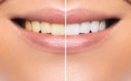 Quick Teeth Whiting Tips Before a Big Event