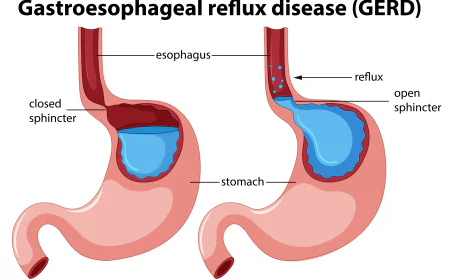 Managing Acid Reflux and GERD: Expert Guidance from the Best Gastroenterologist in Dubai
