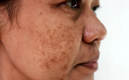 Melasma Treatment: How to Reduce Dark Spots Safely