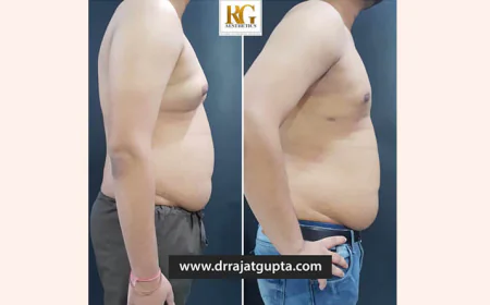 How is Scarless Gynecomastia Surgery Possible in India By Dr Rajat Gupta?