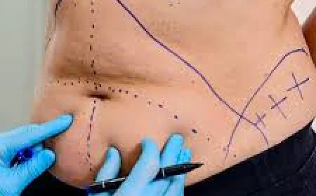 Liposuction in Islamabad – A Complete Guide to Body Contouring and Fat Removal