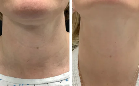 Best Doctors in dubai for Collagen-Boosting Radiofrequency Microneedling