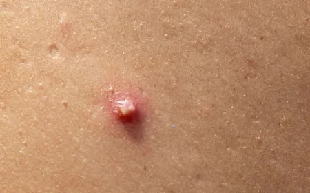 Skin Tag Removal in Dubai: Trusted Skin Specialists Guide