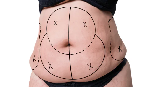 Tummy Tuck in Dubai for Smooth, Refined, and Elegant Stomach