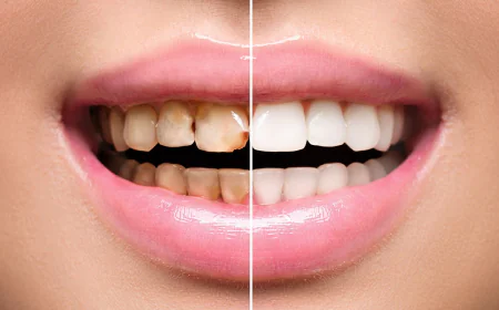 Teeth Scaling and Polishing in Islamabad: Complete Oral Care Guide