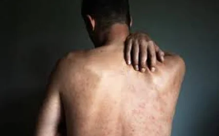 How Do Doctors Diagnose and Treat Shingles Effectively?