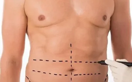 Body Jet Liposuction in Islamabad: Recovery Timeline and Expectations