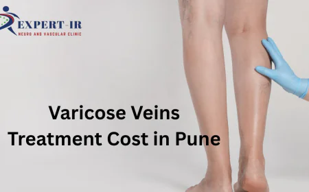 Varicose Veins Treatment Cost in Pune – What to Expect
