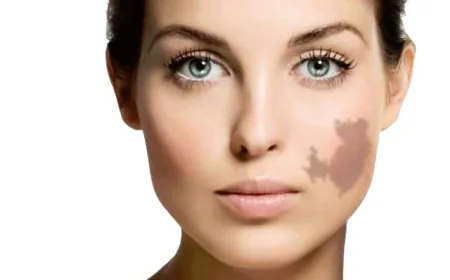 Birthmark Removal in Dubai: Experience Clear, Smooth Skin