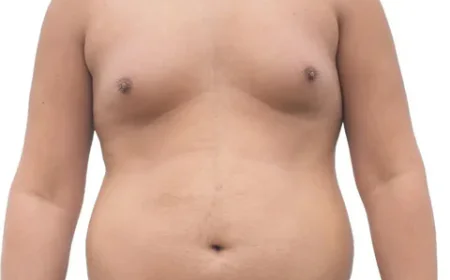 What Is Gynecomastia? Causes, Symptoms, and Treatment Options