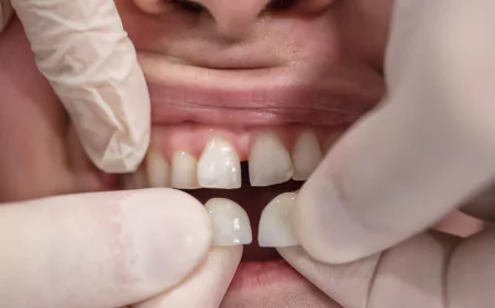 Dental Veneers in Diamond Bar, CA | Trusted Dentist in Diamond Bar