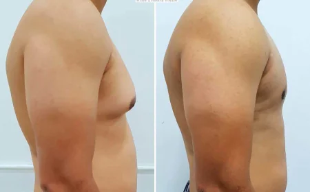The OCCULT Technique for Gynecomastia