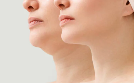 Chin Liposuction in Dubai: Budget-Friendly Contour Upgrade