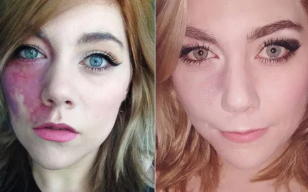 Birthmark removal in Riyadh for large or deep birthmarks