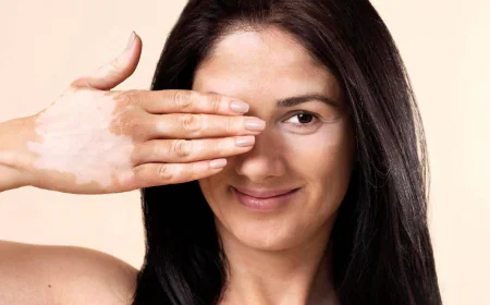 Best Vitiligo Cream & Vitiligo Home Remedy
