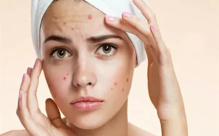 Use of chemical peels for pimples treatment in Riyadh