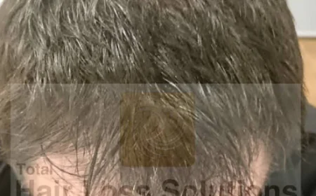Best Hair transplants in Yorkshire