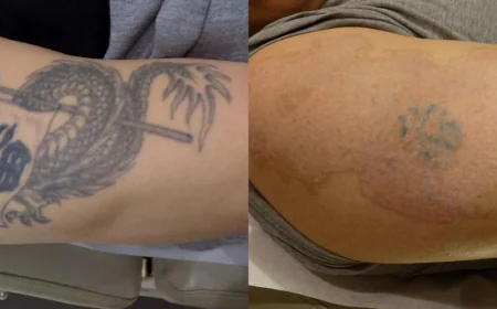 Tattoo Removal Brentwood: Safe Solutions for All Skin Types