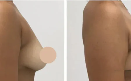 Advanced Techniques for Breast Lift in Dubai