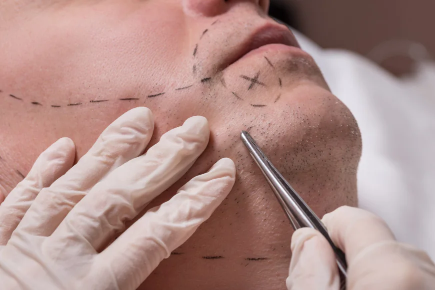 Top Benefits of Getting a Beard Hair Transplant in Dubai